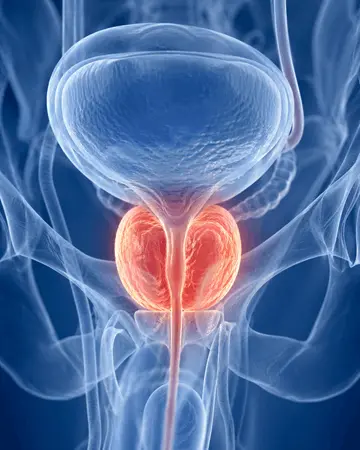 cancer_prostata_anatomia_prostata_inflamada_diagnostico_urologico_queretaro_360x450 Ilustracion de prostata inflamada representando cancer de prostata y su diagnostico