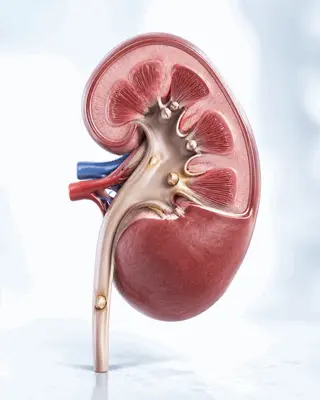 piedras_en_los_rinones_calculos_renales_urologia_queretaro_320x400 Ilustracion anatomica de riñon con piedras en los riñones y calculos renales